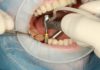 Implanturile dentare: cum functioneaza si din ce sunt facute functionare implant dentar