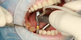 functionare implant dentar