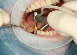 functionare implant dentar