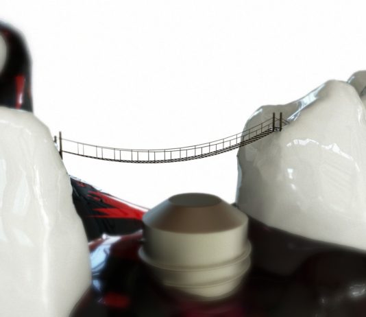 Durata de viata a unui implant dentar si avantajele alegerii acestei solutii de inlocuire a dintilor pierduti implant dentar in Bucuresti
