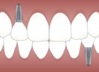 Rata de succes a procedurii de inserare a unui implant dentar clinica dentara Elveto Dent