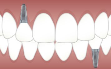 Rata de succes a procedurii de inserare a unui implant dentar clinica dentara Elveto Dent