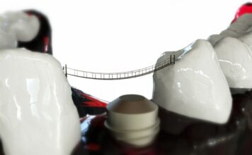 Tipuri de implant dentar de top disponibile in Romania