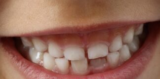 Igiena dentară la copii: ghid complet pentru o sănătate orală impecabilă Igiena dentară la copii