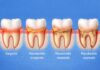 Care sunt etapele bolii gingivale? Cabinet stomatologic Ploiesti